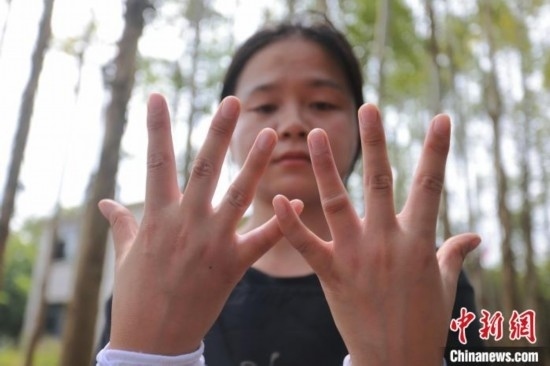 吳素英展示被蜜蜂蜇過的雙手。湯曉逵 攝