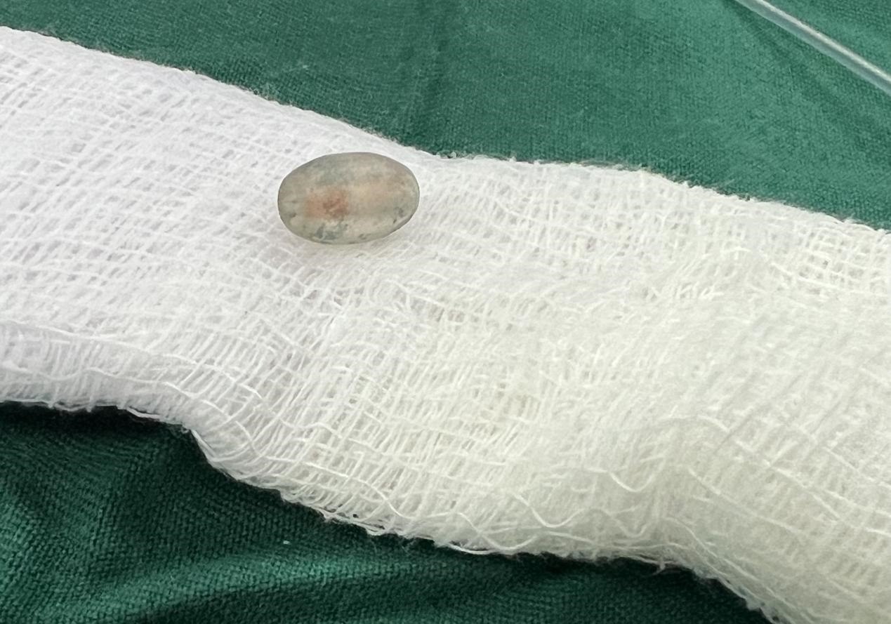 被取出的異物。中國援桑醫(yī)療隊供圖