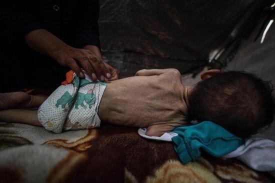 這是5月28日在加沙城西部一處臨時安置點(diǎn)拍攝的一名營養(yǎng)不良的嬰兒。新華社發(fā)（馬哈茂德·扎基攝）